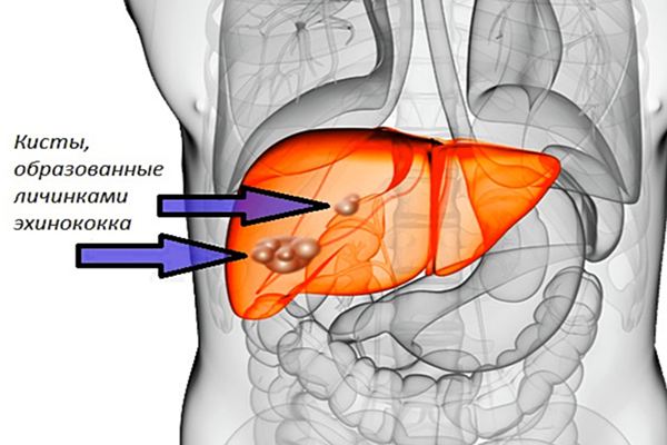 Кисты печени: причины, симптомы. Лечение кисты печени в СПб