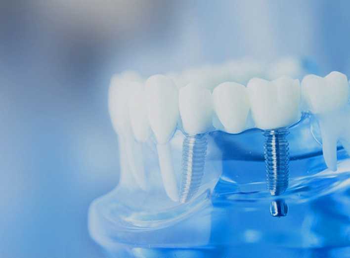 Эффективность процедуры имплантации зубов