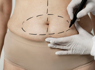 Абдоминопластика после похудения: как восстановить фигуру после большой потери веса