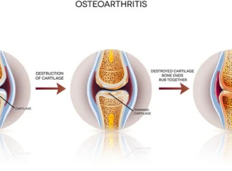 Остеоартроз: причины развития и эффективные методы лечения