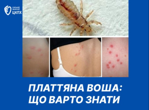 У Сумах зростає кількість випадків зараження платтяними вошами: як убезпечитися фото У Сумах зростає кількість випадків зараження платтяними вошами: як убезпечитися фото