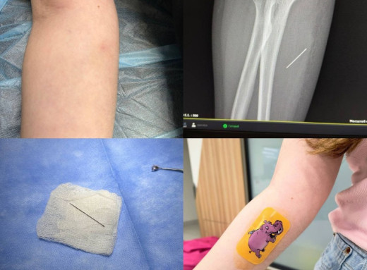 Тиждень з голкою в руці: на Львівщині 13-річній школярці провели операцію фото