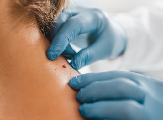 Родимки та меланома - на які зміни радить звертати увагу сумська лікарка фото